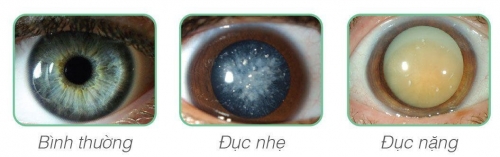 Vì sao ngày càng có nhiều người mắc bệnh đục thủy tinh thể? Vì sao ngày càng có nhiều người mắc bệnh đục thủy tinh thể?