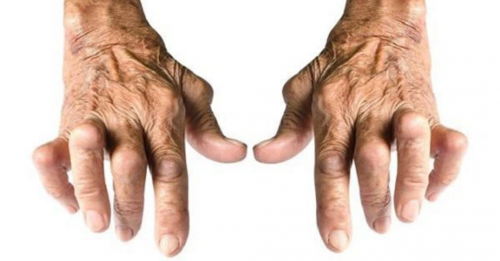 Thấp khớp khiến người gia mất tự tin vào cuộc sống Thấp khớp khiến người gia mất tự tin vào cuộc sống